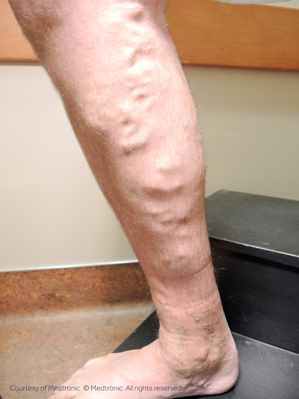 Before photo of a patient with varicose veins