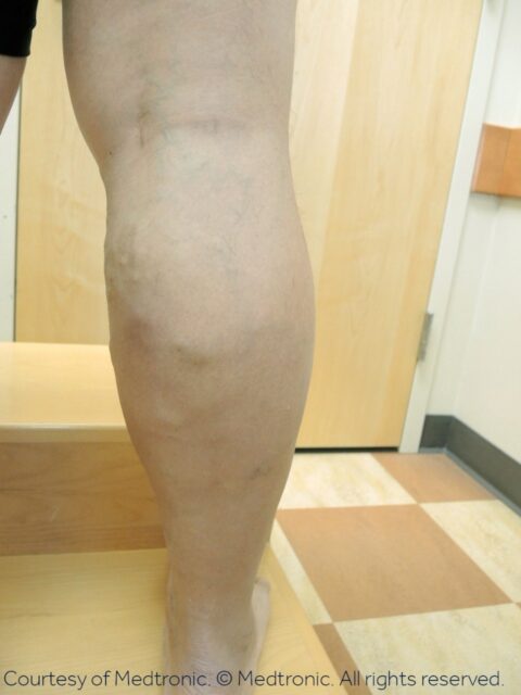 After photo of a patient with varicose veins. Courtesy of Medtronic. Copyright Medtronic. All rights reserved.