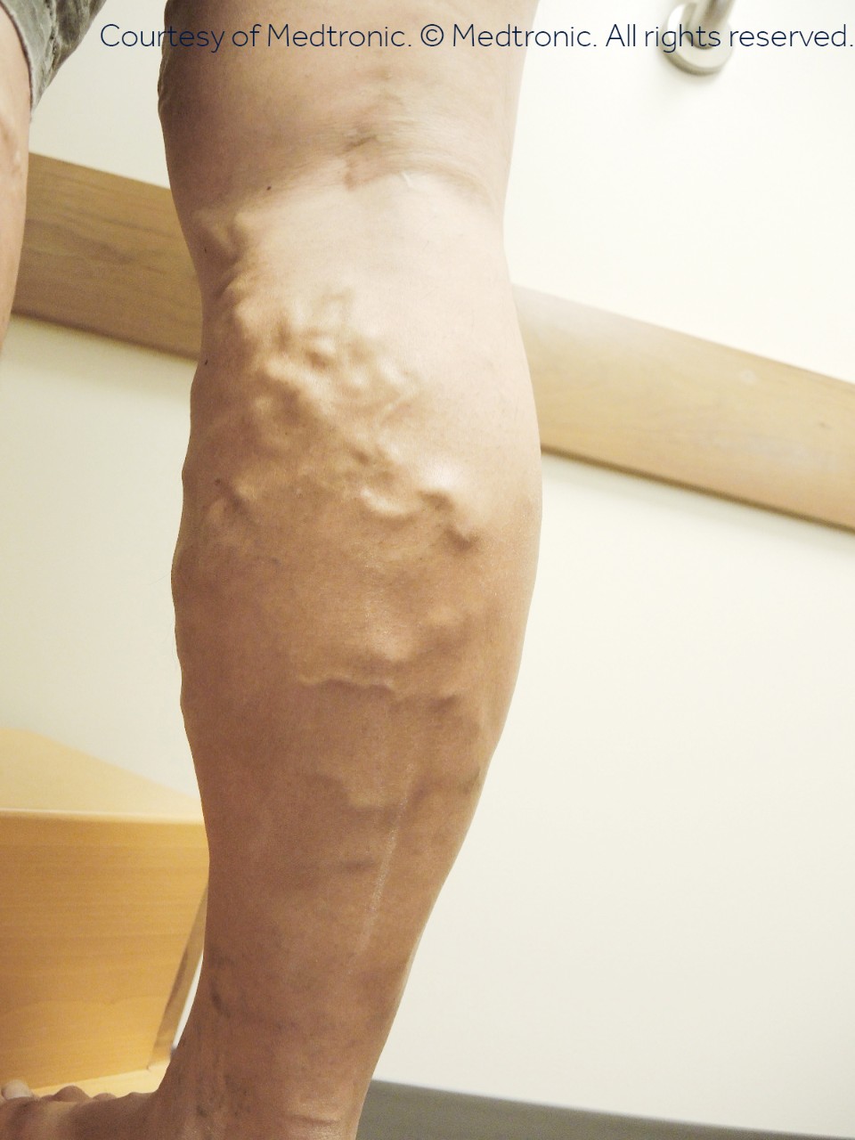 Before photo of a patient with varicose veins
